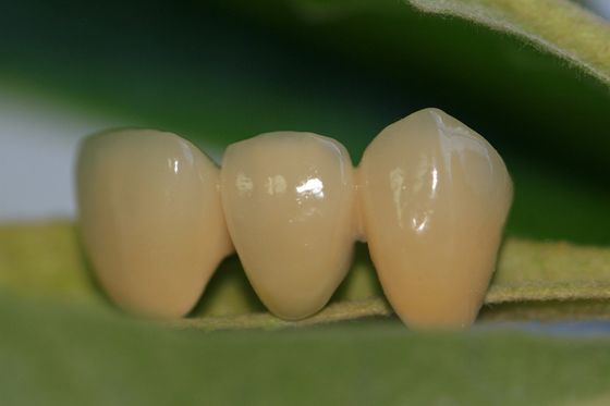 Laboratorium Desain Gigi Keramik Penuh ISO13485 Zirkonia Dental Crown Untuk Gigi Anterior