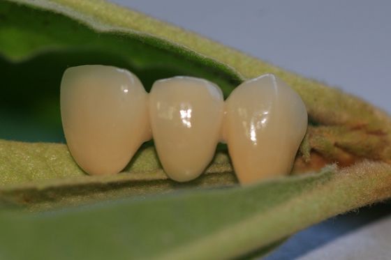 Resin Mahkota Sementara Warna Alami Komposit Untuk Gigi Anterior