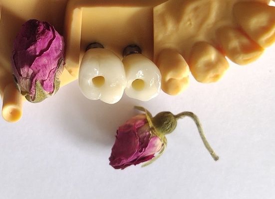Jembatan Cemented Implants Crowns