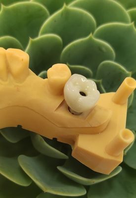 Jembatan Cemented Implants Crowns