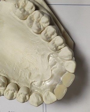 Nyaman Sesuai ISO13485 RPD Gigi Tiruan Tak Terlihat Lembut