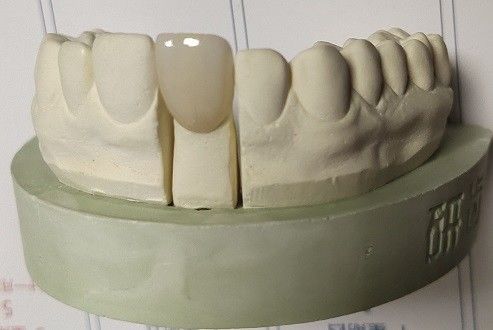 Zirkonia Memblokir Cetak 3D Gigi Dengan Penggilingan CAD CAM