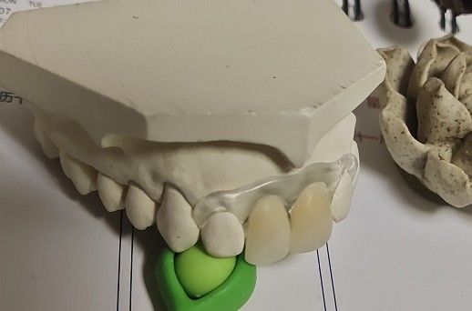 Gigi Tiruan Tak Terlihat Valplast Lembut Dan Elastis Sementara