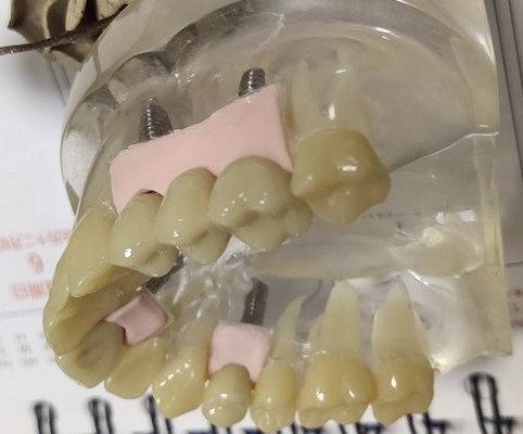 100 Persen Biokompatibilitas PMMA Provisional Crown
