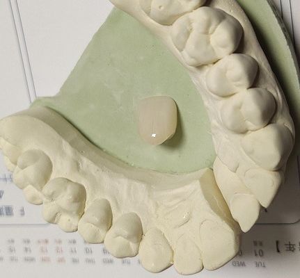 Resin Mahkota Sementara Warna Alami Komposit Untuk Gigi Anterior