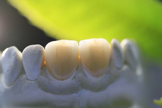 Kerangka Cetak 3D Mahkota Lab Gigi PFM Untuk Kedokteran Gigi