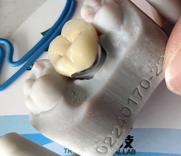 Produk Lab Gigi CAD CAM PFM Mahkota porselen menyatu dengan logam