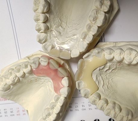 Gigi Tiruan Tak Terlihat Bebas Logam Resin Untuk Pasien Alergi